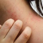 TYPES D'ECZEMA